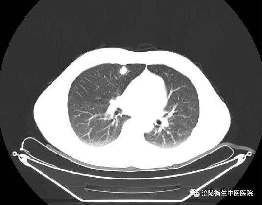 菠萝蜜二区三区4区 连续成功开展3例胸腔镜下肺癌根治术